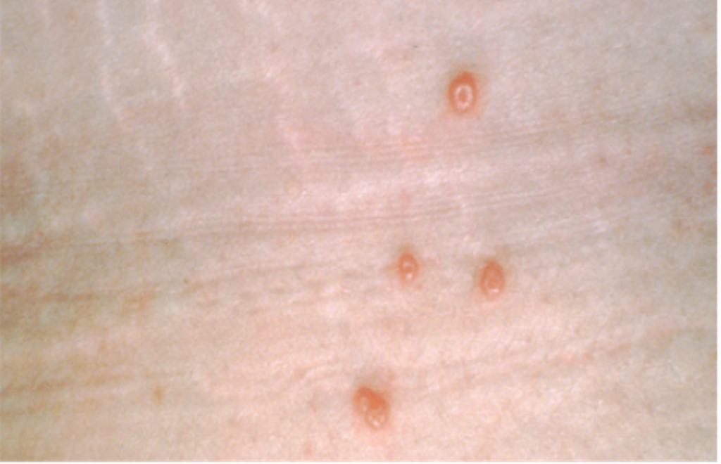 Molluscum Contagiosum - Yuma Dermatology